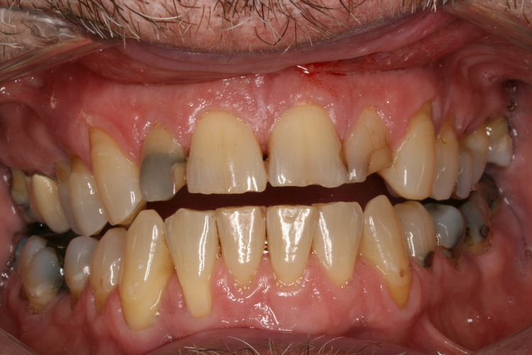  Broken Down Anterior Teeth