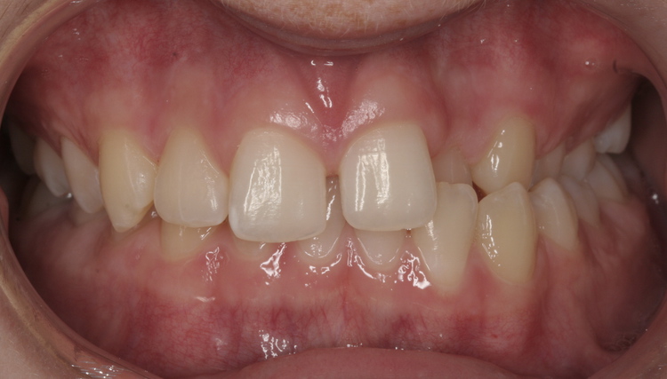 preop_ortho_Tucker Pre-Op Orthodontics