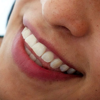 Stopping the Grind of Bruxism