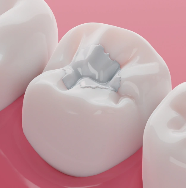 Treating Cavities Without Compromising Your Smile