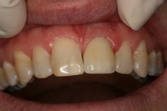 After Fractured tooth repaired all ceramic crown