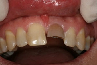 Fractured discolored tooth