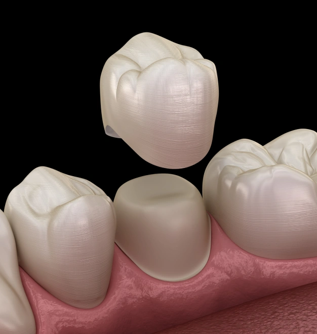 Protecting a Tooth That Has Lost Its Strength