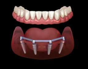 Full Mouth Dental Implants (All-on-4 and All-on-6)