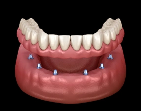 Implant Supported Dentures