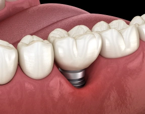 Mini Dental Implants