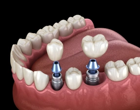 Multiple Tooth Implants