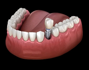 Single Tooth Implants