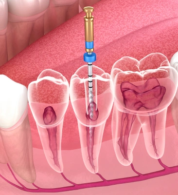 Rotary Endodontics