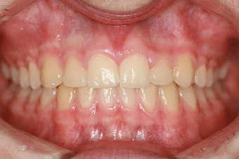 Post-Op Orthodontics