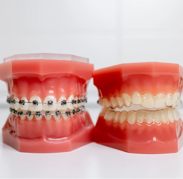 Dental model showing orthodontic braces treatment