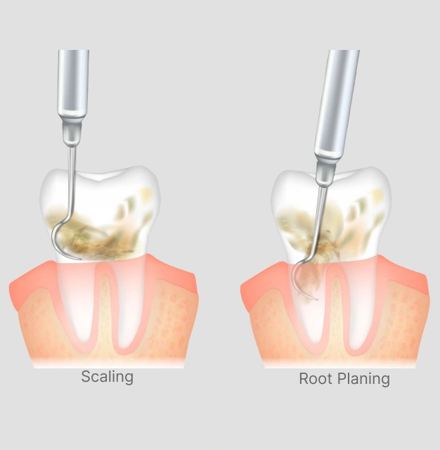 Illustration of scaling and root planing treatment for gum disease