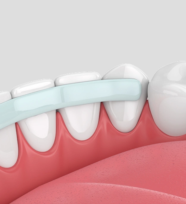 Dental bonding procedure repairing a chipped tooth