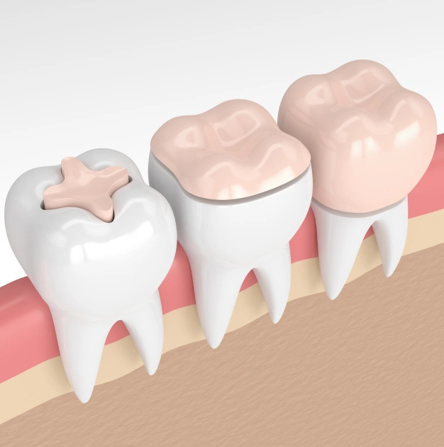 Illustration of dental inlays and onlays restoring damaged teeth