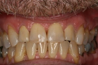 Broken Down Teeth Repaired with Crowns and Tooth Colored Restorations