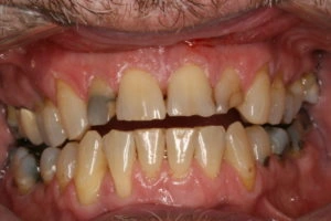 Broken Down Anterior Teeth