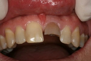 Fractured discolored tooth