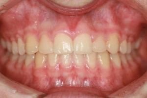 Post-Op Orthodontics