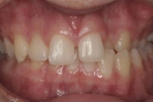 Pre-Op Orthodontics